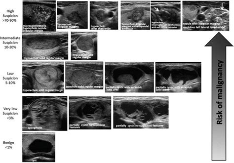 The Application of Sonographic Patterns to Risk Stratification of Thyroid Nodules | Radiology Key