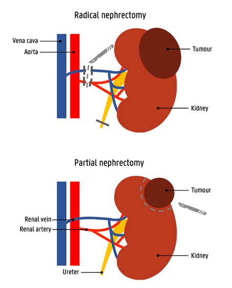 Treatment planning of partial nephrectomy procedures — Institute of Biomedical Engineering and ...