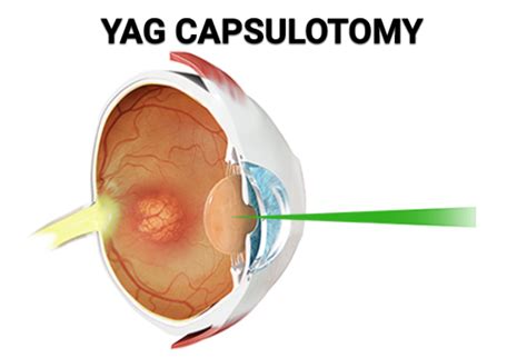 YAG Capsulotomy (YAG Laser Eye Surgery) - Vitreous Retina Macula Consultants of New York