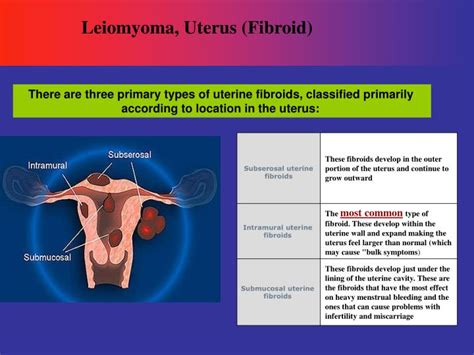 PPT - Leiomyoma, Uterus (Fibroid) PowerPoint Presentation - ID:862850