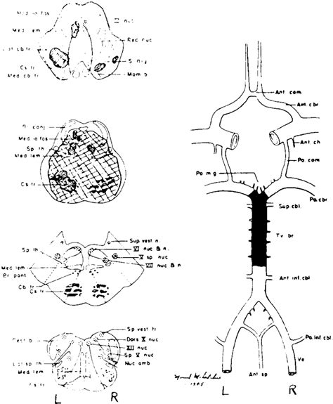 The vascular diagram on the right shows an occlusion of the basilar ...