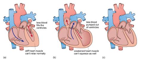 Heart Disease From Alcohol