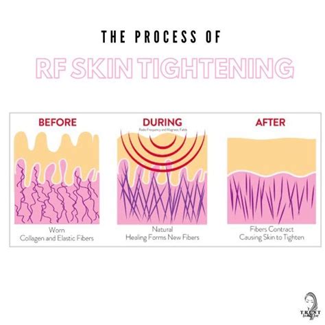 RF Skin Tightening and why you need it! | Body treatments, Body ...