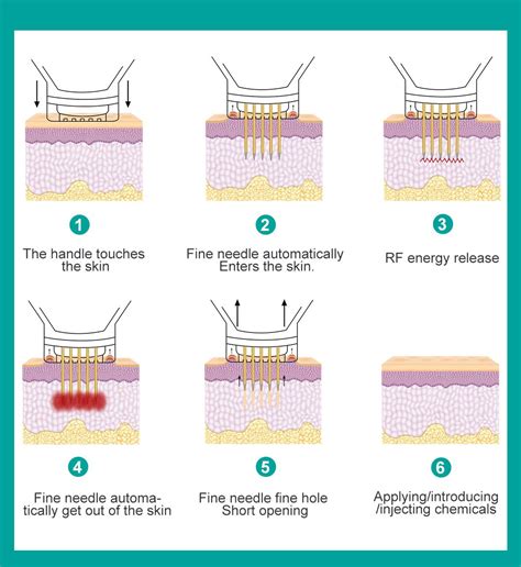 The difference between RF microneedling and fractional laser treatment