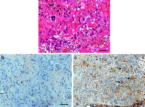 Photomicrographs of histopathology of the pineal tumor showing... | Download Scientific Diagram