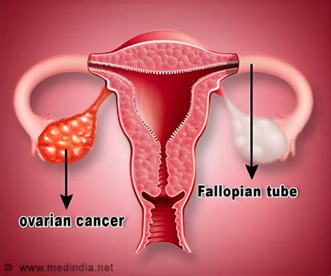How Ovarian Cancer Cells Spread In The Abdomen