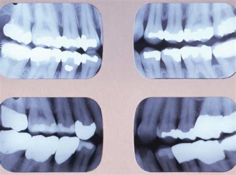 Bitewing X-rays