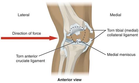 Marcus Kemp ACL & MCL Tear | Sports Blog