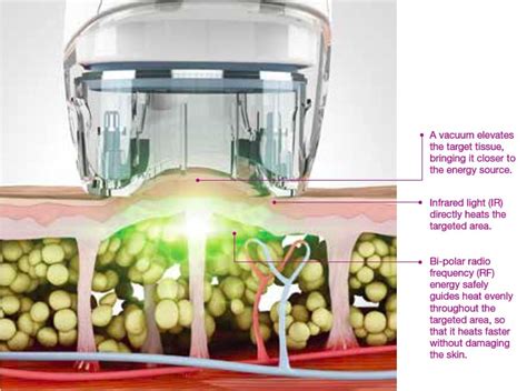 VelaShape III - UnionDerm - The Art + Science of Skin