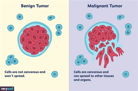 Benign Lung Tumors: Types, Characteristics, and Treatment