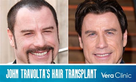 John Travolta's Hair Transplant