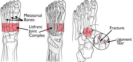 Anatomy of a Lisfranc Injury – My Frenemy, Lisfranc