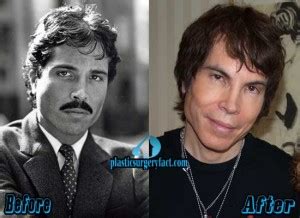 Gerald Posner Plastic Surgery Before and After