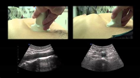 Ultrasound in the Diagnosis of Abdominal Aortic Aneurysm - YouTube