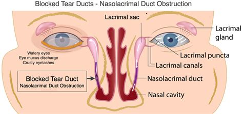 Tear Duct Surgery or Dacryocystorhinostomy (DCR)