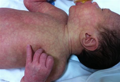 Neonate with marbled skin appearance (cutis marmorata telangiectasia congenita) | Pediatric ...