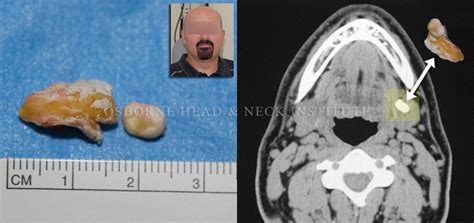 Sialendoscopy for Salivary Gland Stone Treatment