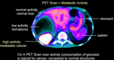 Does A Pet Scan Show Brain Cancer - CancerWalls