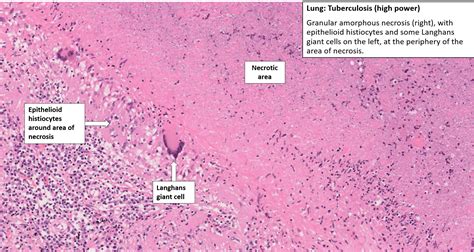 Tuberculosis Lymph Node Histology