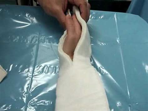 Radial Gutter Splint application - YouTube