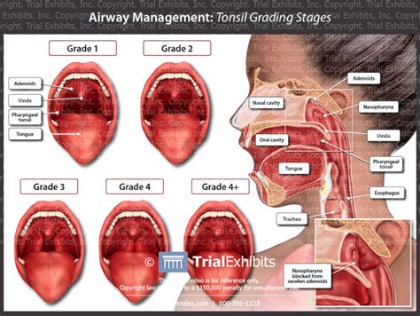 Airway Management: Tonsil Grading Stages | Trial Exhibits, Inc.