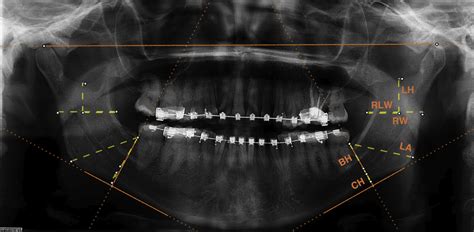 Computed measurements on orthopantomograms of patients with and without ...