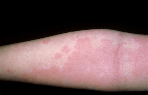 What 10 Common Skin Rashes Look Like C8A