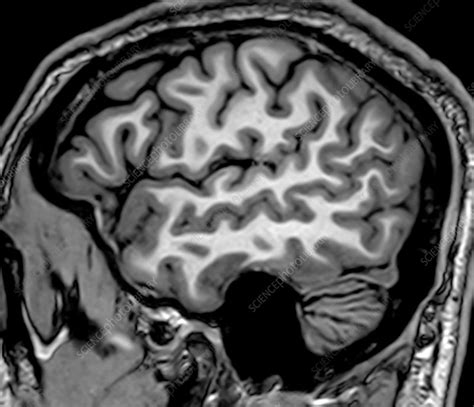 Normal Sagittal T1 MRI Brain 1 - Stock Image - C039/3731 - Science Photo Library