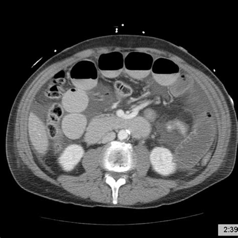 Bowel obstruction CT - wikidoc