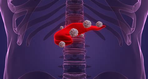 Preoperative combination chemotherapy improved survival in patients ...