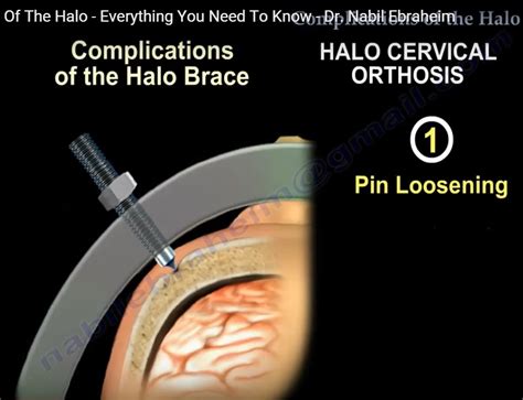 Complications of the #Halo — OrthopaedicPrinciples.com