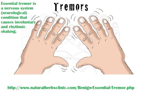 Living with essential tremors – Artofit