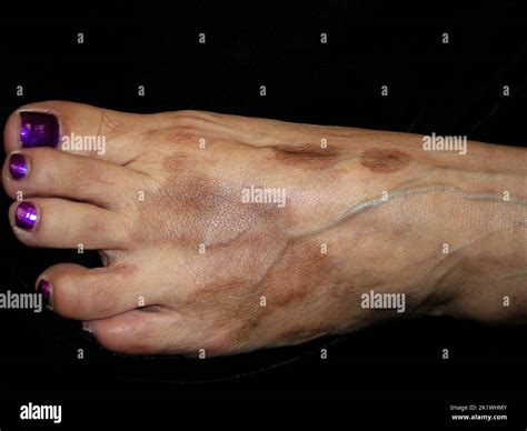 Pigmented purpuric dermatosis Schamberg Stock Photo - Alamy