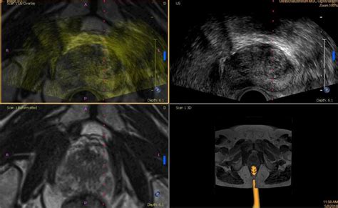 MRI-TRUS fusion biopsy of the prostate: Quality of image fusion in a ...