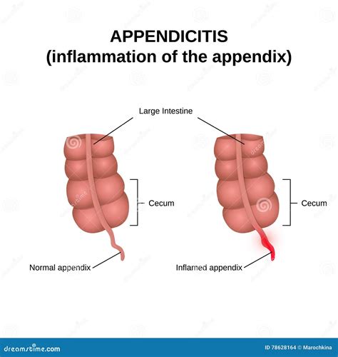 Inflammation of the Appendix Stock Vector - Illustration of abdominal, blockage: 78628164