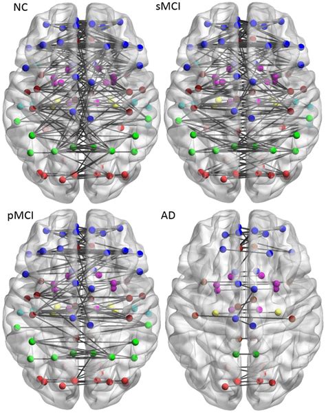 Brain connectivity graphs in NC, pMCI, AD and sMCI. Brain inter-... | Download Scientific Diagram