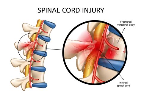 Acute Spinal Cord Injury | Aurora Health Care