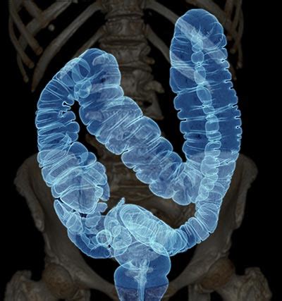 CT Colonography - Reading - Berkshire Imaging