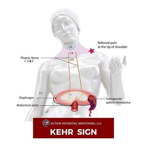 Kehr's Sign refers to left shoulder... - Action Potential AP