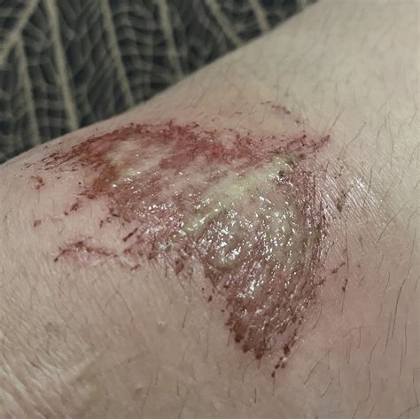 Day 2 since I scraped my knee, is this healing normally? : r/firstaid