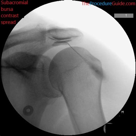 Fluoroscopic Guided Shoulder Subacromial Bursa (SAB) Injection - The Procedure Guide