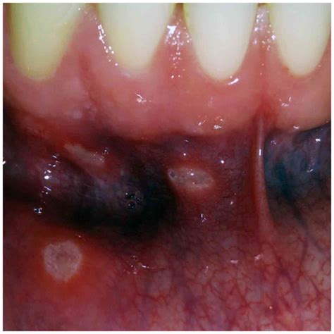 Aphthous Stomatitis Treatment