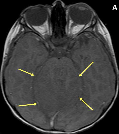 Medulloblastoma - MRI Online