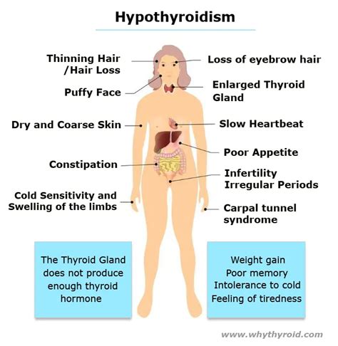 Hypothyroidism - Cause, Symptoms, Treatment, Diet - Why Thyroid