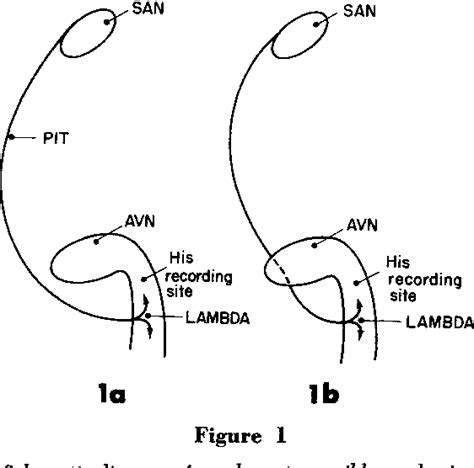 Figure 1 from Lown‐Ganong‐Levine Syndrome | Semantic Scholar