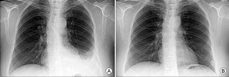 Chest X-ray shows left costophrenic angle blunting which is indicated... | Download Scientific ...