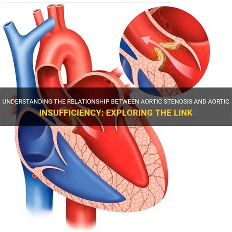 Understanding The Relationship Between Aortic Stenosis And Aortic ...