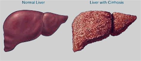 How Long Can Someone Live With Stage 4 Cancer - CancerWalls