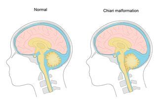 Chiari malformation type 1 - holoserdual