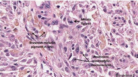 Malignant Melanoma Histology